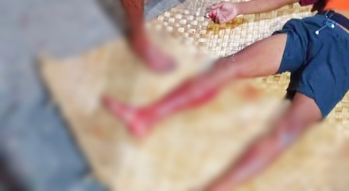 Warga Desa Fogi di Bursel Selamat dari Terkaman Buaya dan Jalani Perawatan